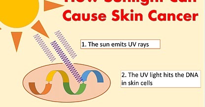 Your Skin for Life: Why the Sun Causes Skin Cancer