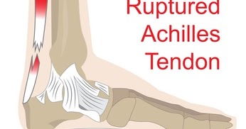Texas Orthopedics: Update on Achilles Tear Repair