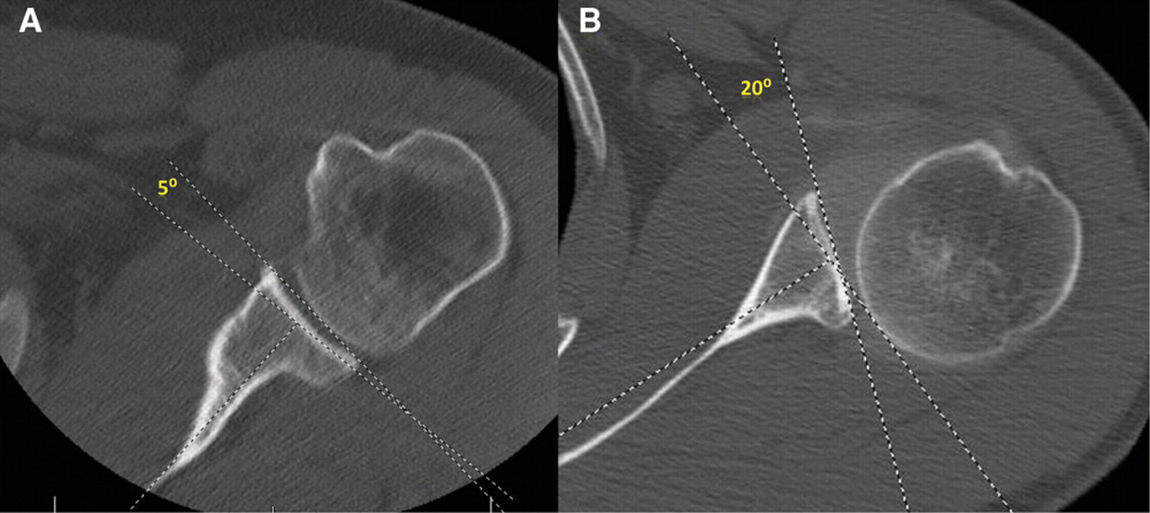 FTK Sports Medicine Bony Adaptation of the Shoulder in Baseball Pitchers
