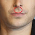 Long Philtrum Female & Male Causes, Surgery|Celebrities with Long Philtrum