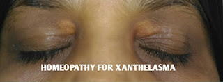 Xanthelasma Homeopathic treatment 