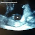 Najluđi ultrazvuk snimak jedne bebe, ikada... ( VIDEO )