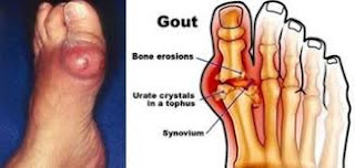 MEDICINE GOUT