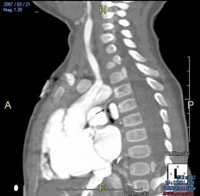 PediCardiology Quiz Answers: Quiz #6: Barium Swallow Answers