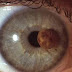 Cancer de l oeil traitement