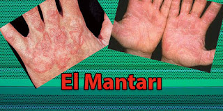 El Mantarı mantar tedavisi