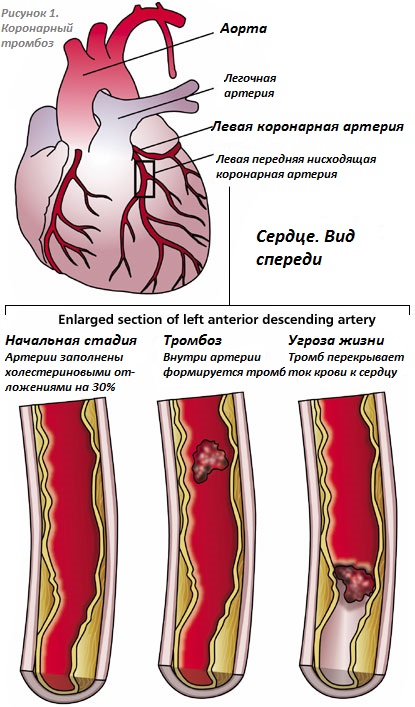 Тромбоз артерий лечение. Тромбоз венечных артерий сердца. Тромб коронарных артерий сердца. Тромбоэмболии коронарного сосуда. Тромб в коронарной артерии.
