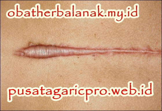 Penyakit Keloid dan Cara Mengobatinya Penyakit Keloid dan Cara Mengobatinya