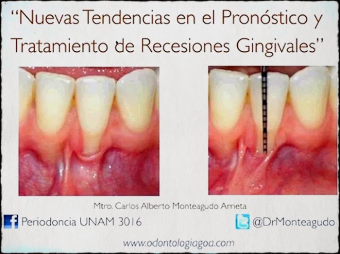 RECESIÓN GINGIVAL: Nuevas tendencias en el pronóstico y tratamiento - Mtro. Carlos Alberto Monteagudo Arrieta