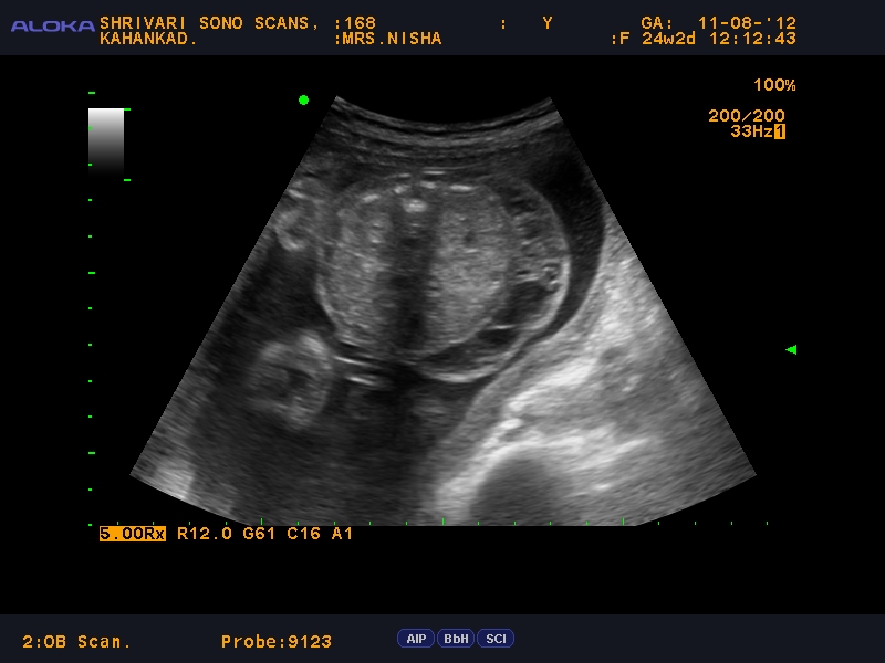 Shrivari Sono Scans fetal abdominal wall septated cystic