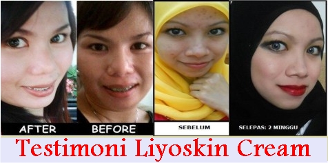 Nama Cream Penghilang Flek Hitam Liyoskin Nama Cream Penghilang Flek Hitam