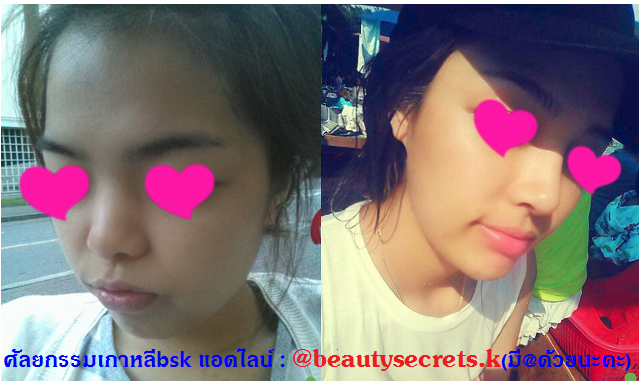 รีวิวศัลยกรรมเกาหลี เอเจนซี่BSK : ศัลยกรรมจมูกอย่างเดียวได้หน้าใหม่ ศัลยกรรมเปลี่ยนชีวิต!! รีวิวศัลยกรรมเกาหลี เอเจนซี่BSK : ศัลยกรรมจมูกอย่างเดียวได้หน้าใหม่ ศัลยกรรมเปลี่ยนชีวิต!!