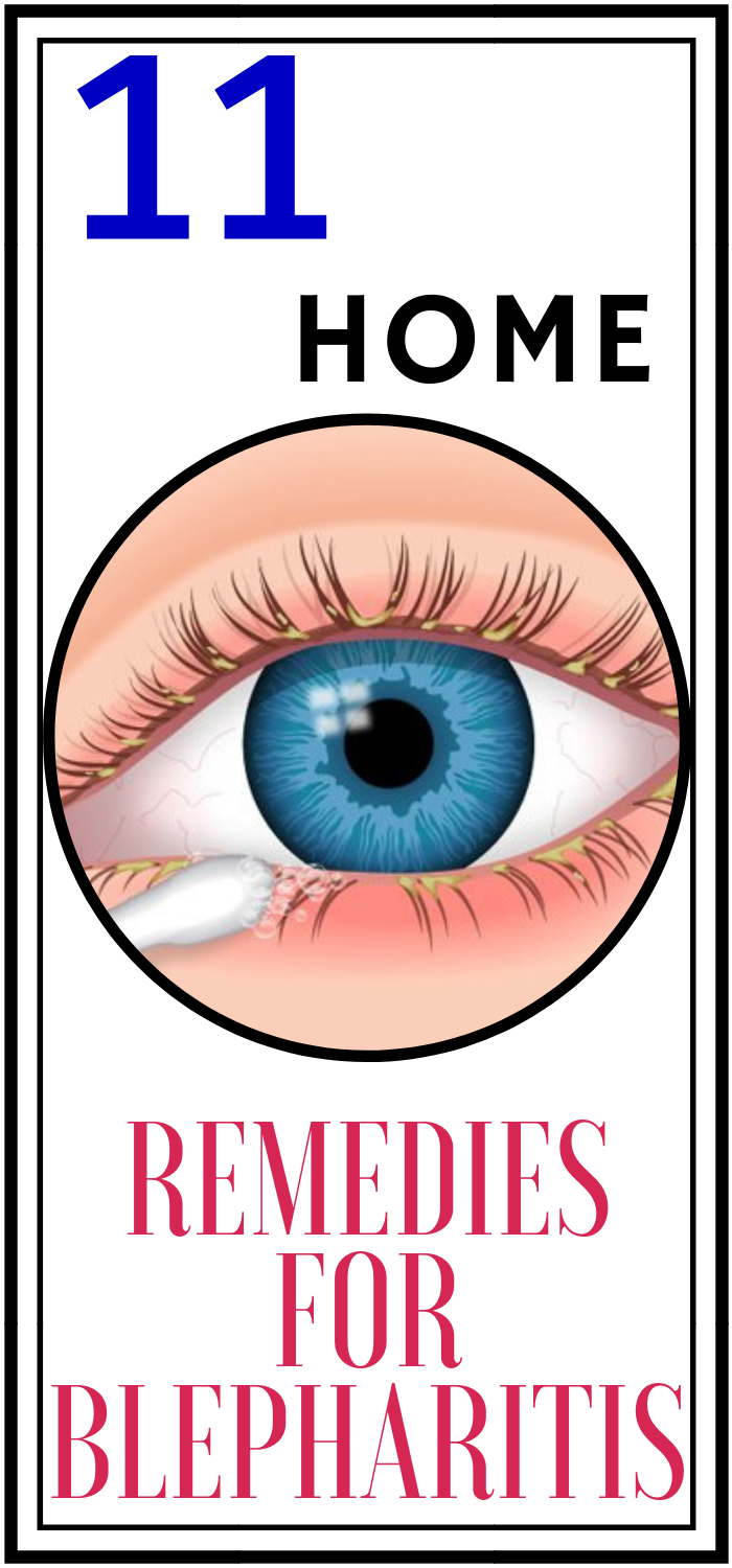 Run Healthy Lifestyle 11 Home Remedies for Blepharitis