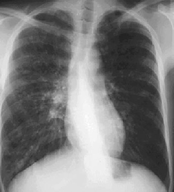 Bronchiectasis X RAY features