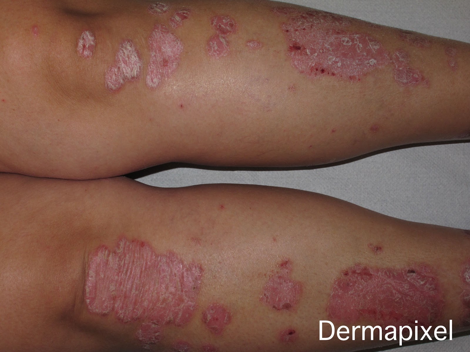 Dieta para mejorar la psoriasis