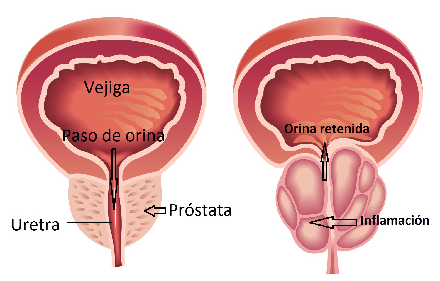 ¿Por qué la prostatitis te cansa? ¿Por qué la prostatitis te cansa?