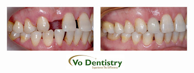 Dental Implants