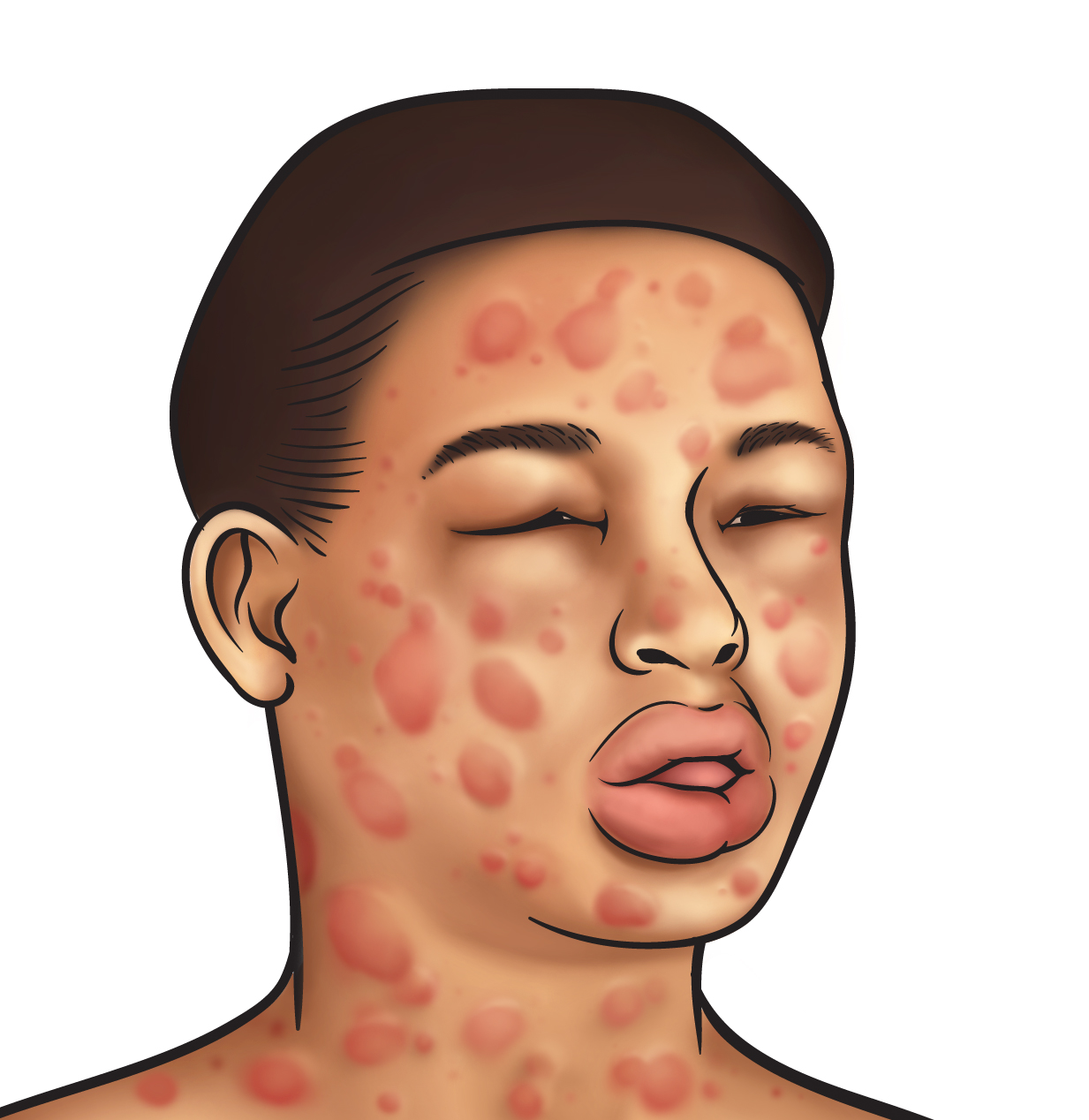 Clinical Manifestations of Anaphylaxis Nanda Nurse Diary