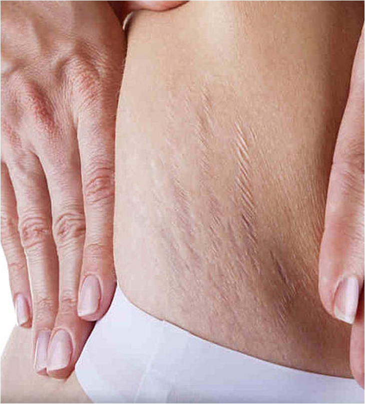 Dermisht y piel de naranja El