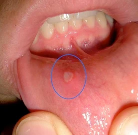 http://www.hindiayurveda.com/home-natural-remedies-for-mouth-ulcers-in-hindi/