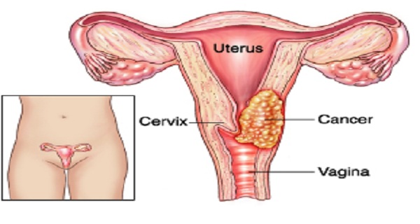 http://cancer-treatment-madurai.com/types-of-cancer-cervical-cancer.php
