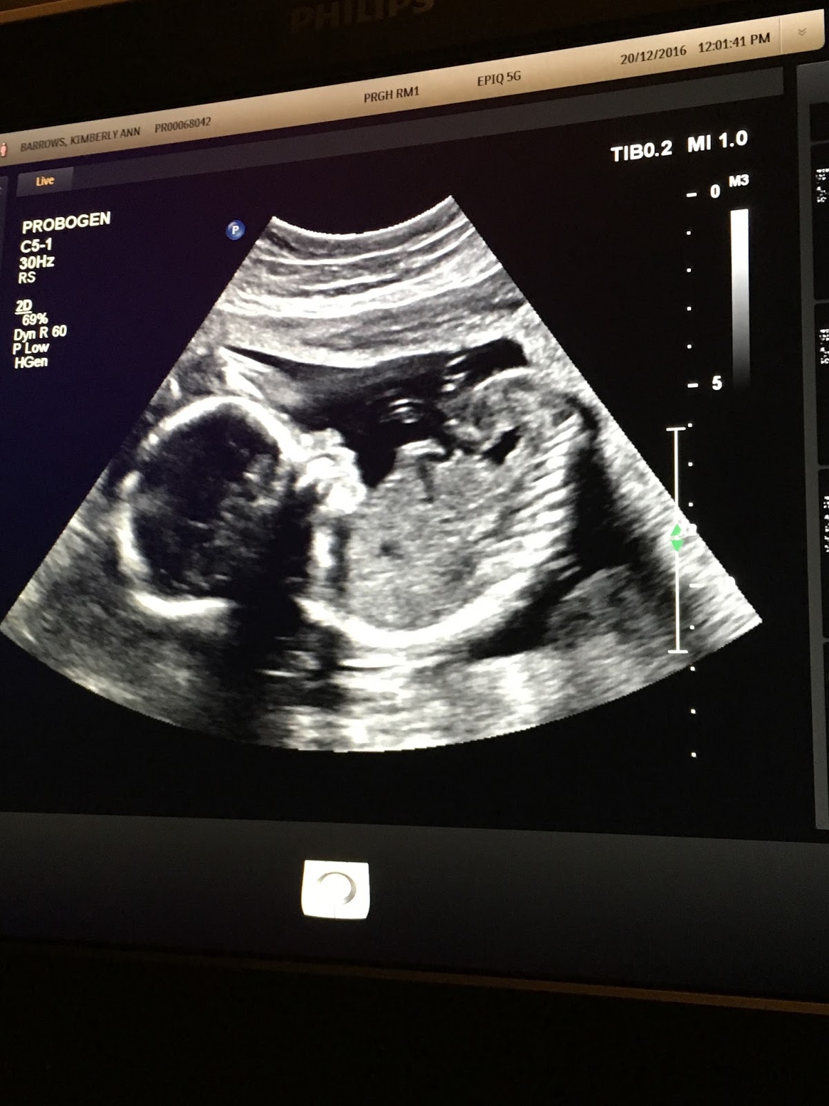 The Barrows Family Adventures 20 week ultrasound photos, videos, the