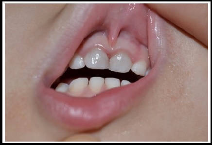 Gejala Awal Gigi Keropos gigi tidak sehat gejala gigi akan keropos pangkal gigi putih tanda pengeroposan gigi anak