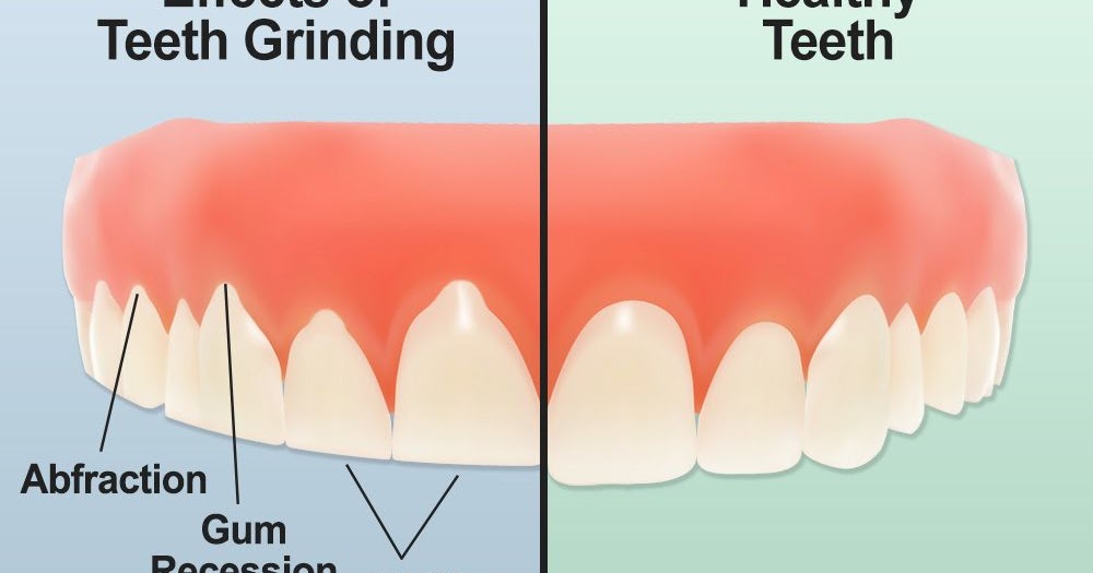 A Healthy Mouth.. My Two Root Canals