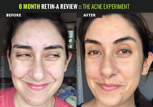 6 Month Retin A Review The Acne Experiment Crappy Candle