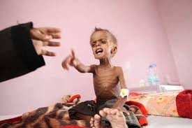 اطفال اليمن يواجهون الموت