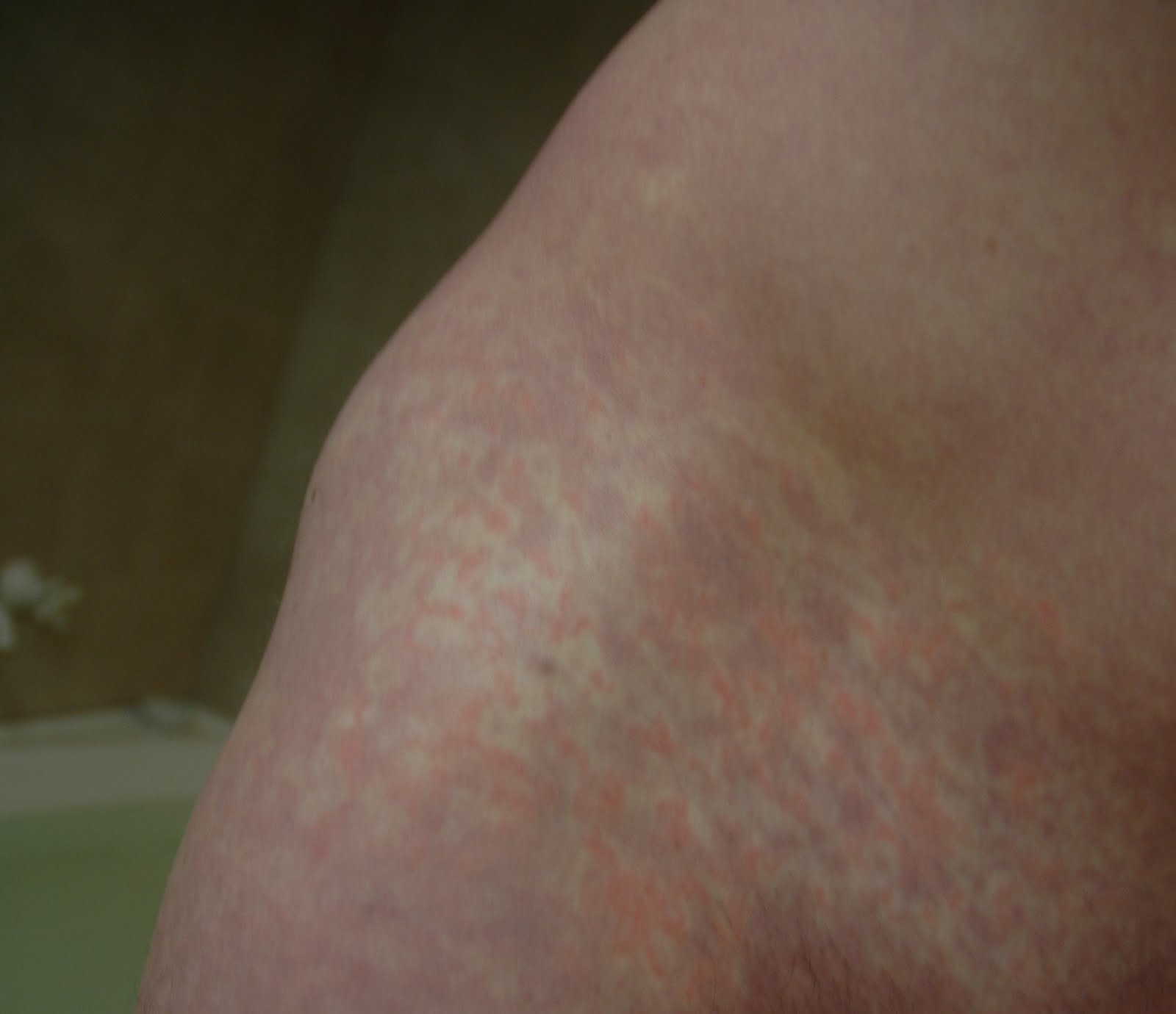 My forearms are very itchy, no rash at all - Virtual Clinic