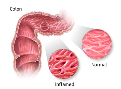 icd 10 code for dehydration icd 10 code for dehydration