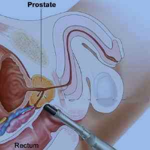 Is an anal prostate test accurate, simran sex kiss pussy