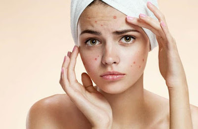 acne on face and neck