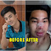 P500 Nose Job Destroys Model's Face