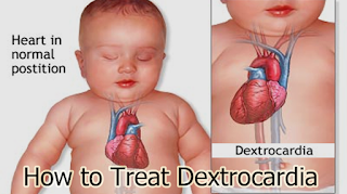 How to Treat Dextrocardia