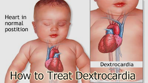 How to Treat Dextrocardia How to Treat Dextrocardia
