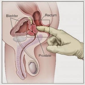 pengobatan ampuh kanker Prostat stadium 3, obat kanker prostat, obat alami kanker Prostat stadium 1