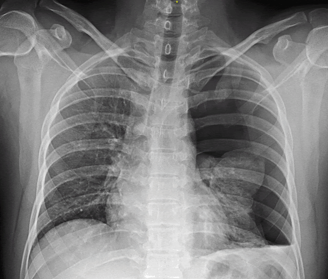 Peut On Mourir D Un Pneumothorax Pneumothorax Symptômes, causes et Traitement