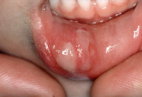 علاج التهابات الفم القروح القلاع بالأعشاب 