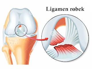 Cara Mengobati Ligamen Robek Secara Alami Cara Mengobati Ligamen Robek Secara Alami