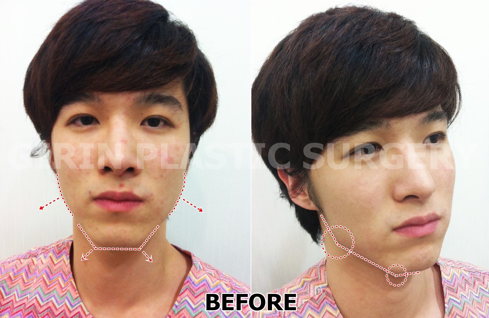 Girin Review New VLine (Jaw reduction)