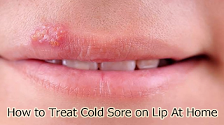 How to Treat Cold Sore on Lip At Home