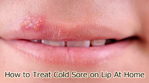 How to Treat Cold Sore on Lip At Home How to Treat Cold Sore on Lip At Home