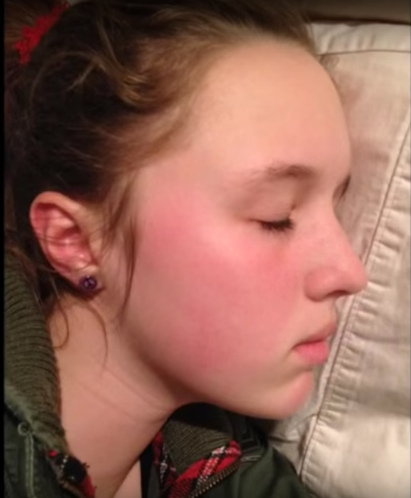 Scarlet Letters, dealing with vascular rosacea, face flushing, burning