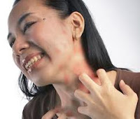 Tips Menyembuhkan Neurodermatitis Secara Alami