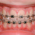 Giải đáp niềng răng mất bao lâu – Trường hợp nào niềng răng không nhổ răng?