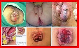 Foto Obat Wasir Produk Asli De Nature Herbal
