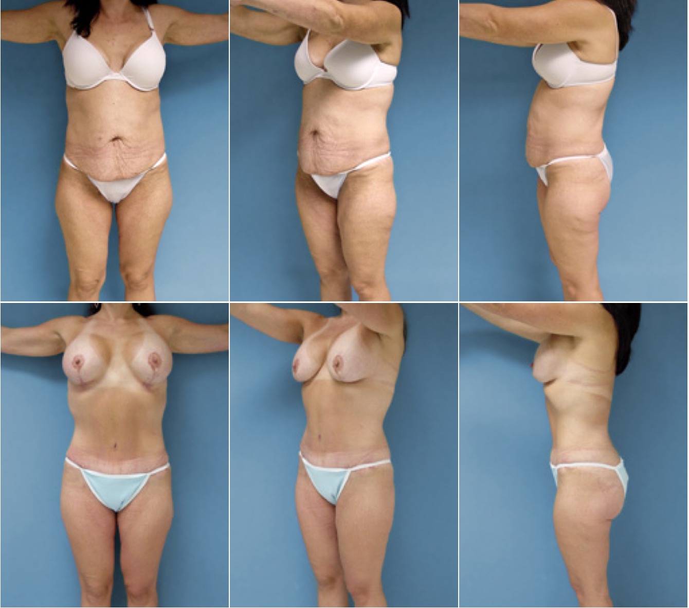 Dating after major weight loss