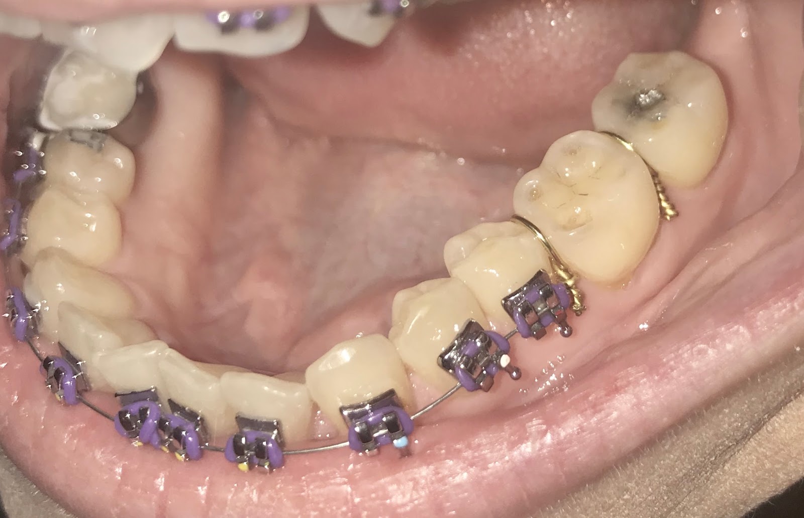 Sarah Says... Day 15, 3 molar bands and metal spacers
